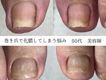 どんな巻き爪も対応可