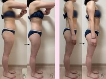 プラスワンビューティテン 新大阪店(Plus One Beauty)/ボディ/ハイパーナイフ/痩身