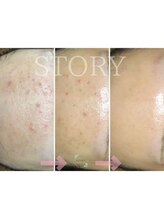 ストーリー(STORY)&nbsp;ハーブ ピーリング