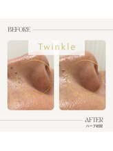 ティンクル(Twinkle)/毛穴の黒ずみ・角栓