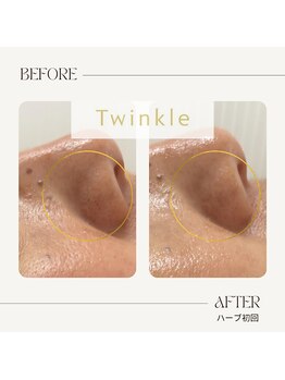 ティンクル(Twinkle)/毛穴の黒ずみ・角栓