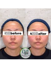 キュープ 相模原淵野辺店(Qpu)/たった4回で人生で1番小さな顔に