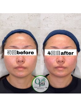 キュープ 相模原淵野辺店(Qpu)/たった4回で人生で1番小さな顔に