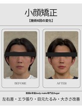 シュガー 津市(Sugar)/BeforeAfter【小顔矯正】