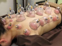 はり灸治療院 えがおの雰囲気（【話題の吸玉】巡りを整え、重だるさを解消！デトックス効果も◎）