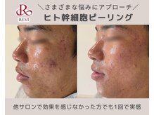laksmi【肌質改善専門店】毛穴/ニキビケア/赤み/ハーブピーリング/プラズマニアの雰囲気(ダウンタイムなし│1回でも効果を実感)