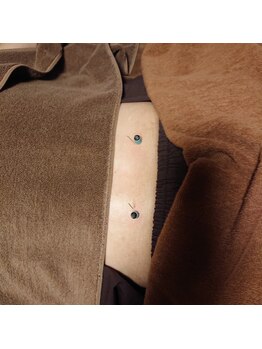 鍼灸ガジュマル/腰痛にお悩みの方