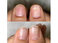 ニューネイル(NEW☆NAIL)の雰囲気（歪んで生えてしまった爪、生え際の腫れ、、、）