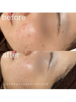ルルラ リコ(lulula rico)/症例写真/ハーブピーリング