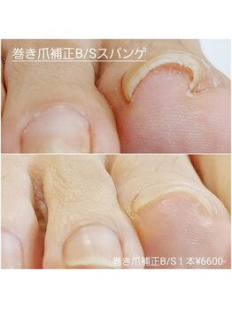 ピピ(PiPi)/【巻き爪B/Sスパンゲ補正】