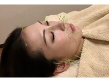 ユー 喜連西店(U)/美容鍼