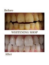 ホワイトニングショップ 今出川店(WHITENING SHOP)/