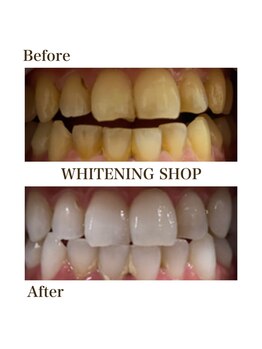 ホワイトニングショップ 今出川店(WHITENING SHOP)/