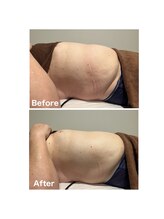 ボディケアアップ(BODY CARE UP↑)/WINBACKお腹集中　２回目の変化