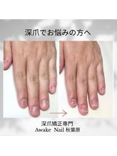 アウェイク ネイル(Awake Nail)/深爪矯正/自爪育成/秋葉原