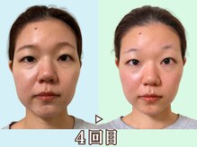 ナチュラルビューティーフェイス 横浜(NBF)/顔のバランスが変わる/小顔横浜