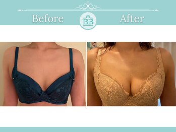 美人バスト 那覇店/バストアップ・育乳◆症例◆
