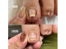 痛みを抑えた巻き爪の改善も可能◎