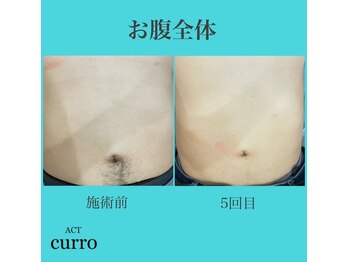 アクト クロ(ACT curro)/【お腹全体】施術例