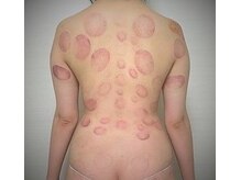 長寿堂 東洋整体院/Wコースカッピング【新宿】