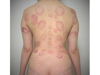 長寿堂 東洋整体院/Wコースカッピング【新宿】