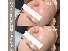 スキンベイビー 池袋店(Skin Baby)の雰囲気（幹細胞フェイシャルで肌を根本から変えていくことが可能！）