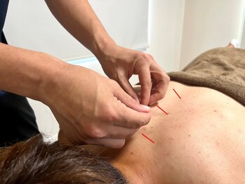 上楽スポーツ鍼灸院の写真/【鍼灸を受けたことがある方にもオススメ】整体SETメニューで体も心もすっきり整います★眼精疲労にも◎