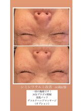 アンジュ/プラズマ１回ビフォーアフター