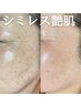 【８月クーポン】根本！シミ改善！あの頃のお肌へ【残り1名】27,500→12,000