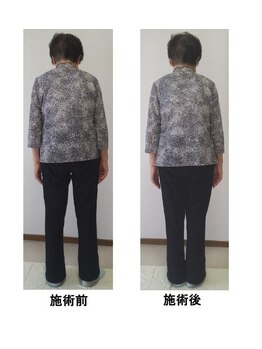 整体処たまゆら/体の歪み・猫背ビフォーアフター
