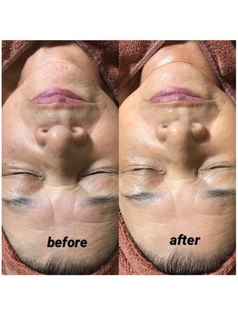 エクレクティック(ECLECTIC)/ピーリング/シミケア/美白