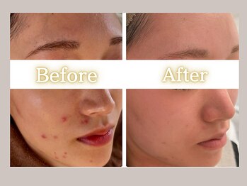 ハル(HARU.)/美肌プログラム5回