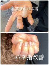 結愛(ゆうあ)/指の痛み改善