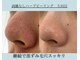 エレナ(ELENA)の写真/【REVI】で頑固な毛穴汚れをごっそり除去★毛穴の開き/黒ずみ/角質除去/肌のごわつきを解消♪