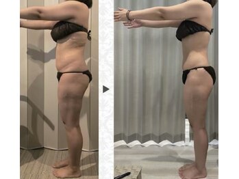 ニュイブラーシュ(nuit blanche)/ポッコリお腹も凸凹セル脂肪も