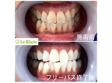 ルブラン 奈良店(Le Blanc)/ストレスフリーで歯を白く！