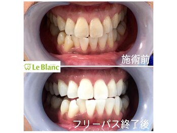 ルブラン 奈良店(Le Blanc)/ストレスフリーで歯を白く!