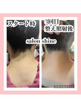 サロンシャイン(Salon Shine)/うなじ脱毛デザイン