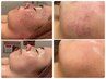 【3ヶ月集中！ニキビケア・赤みモニター】8回コース