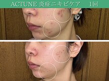 アンナビューティ 六本木 乃木坂店(Anna Beauty)の雰囲気（専用トリートメント内容をその日の肌状況、肌悩みに合わせて作成）