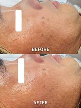 ルーク(Luke)/しみ・くすみケア