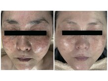 ラキ(LAKI)/ホワイトスノーピール