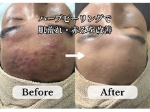 繰り返す肌荒れ・赤みを根本改善◎