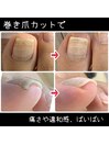 【巻いた爪】違和感バイバイ！