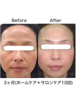 ブレリアントサロン 池袋店(brillant salon)/【40代】年齢肌トータル改善