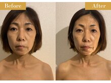 モモスパ(MOMOspa.)/頭蓋骨小顔矯正ビフォアフター