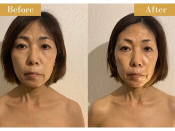 モモスパ(MOMOspa.)/頭蓋骨小顔矯正ビフォアフター