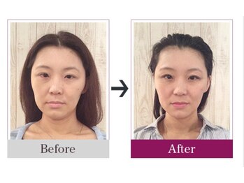 ビコツゼロ 心斎橋(BIKOTSU ZERO)/小顔・顎の歪み・目の高さ違い