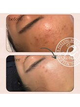 クリア 麻布十番(CLEAR)&nbsp;1回で 肌質改善