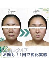 グリーン 町田(Green)/ハイパーナイフ小顔フェイシャル